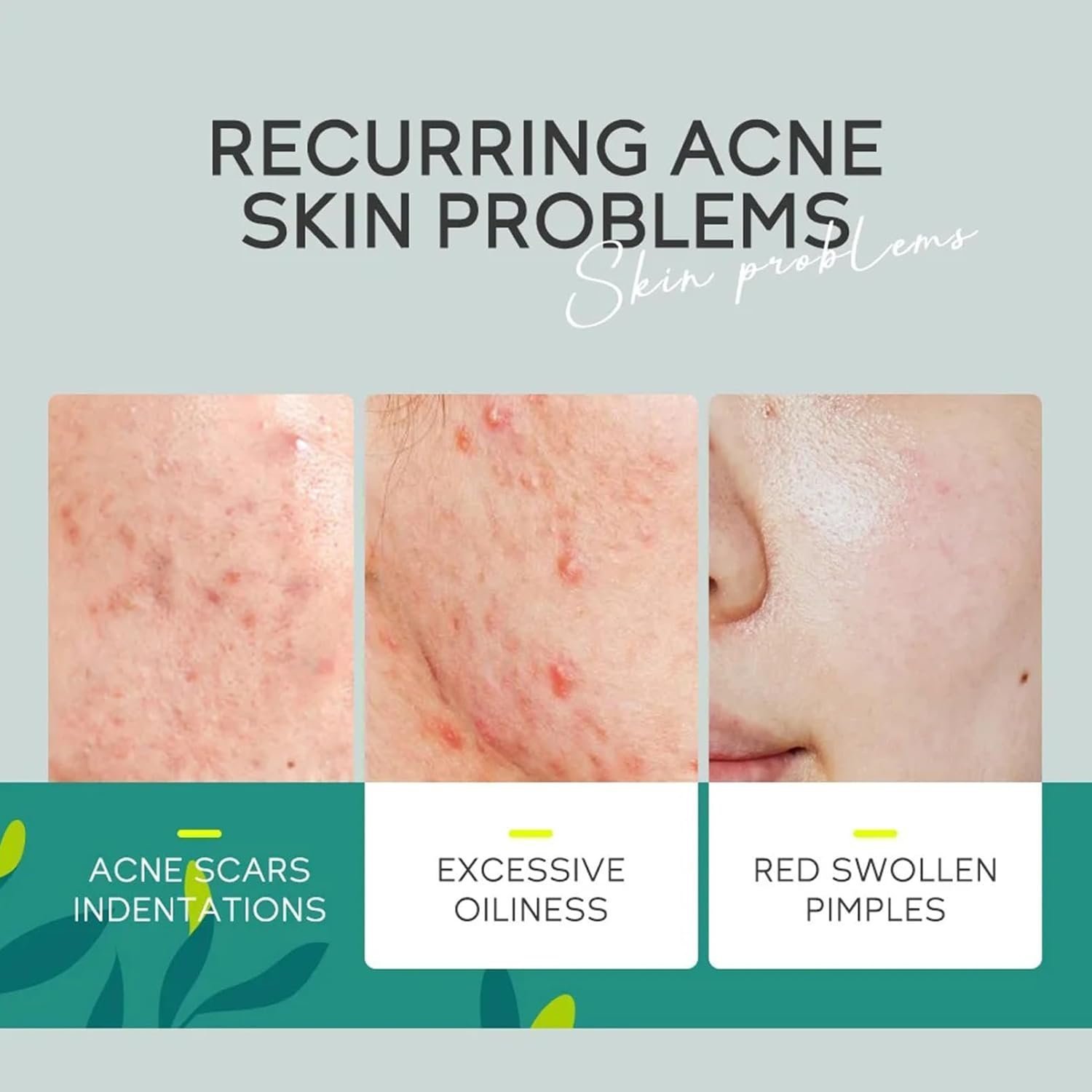 Anti Acne Face Cream, Tea Tree Face Ance Gel, Spot Cream for Acne Treatment and Spot Treatment Shrink Pores, Acne Scars Recovery - Image 3