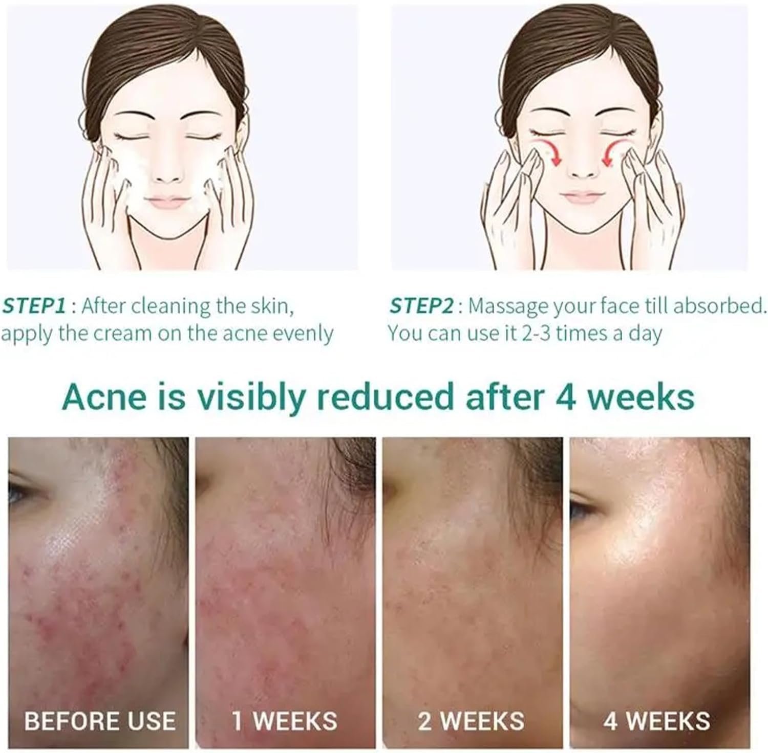 Anti Acne Face Cream, Tea Tree Face Ance Gel, Spot Cream for Acne Treatment and Spot Treatment Shrink Pores, Acne Scars Recovery - Image 5